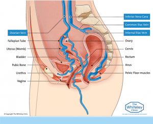 varice uterine)