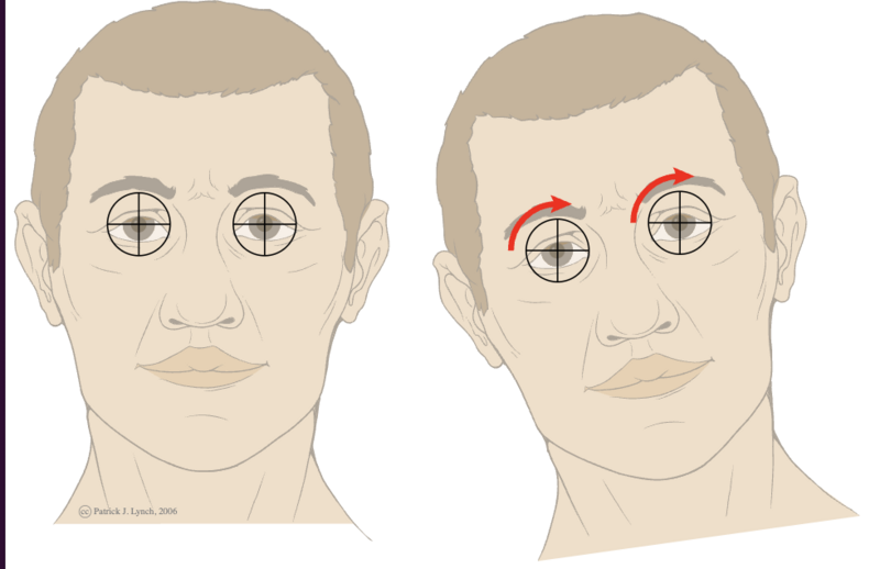 File:Vestibulo-ocular reflex lateroflexion of neck..png
