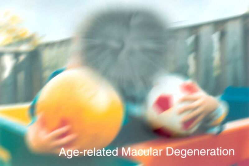File:Age-related macular degeneration EDS05.jpeg
