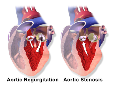 AorticValve RegurgitationvsStenosis.png