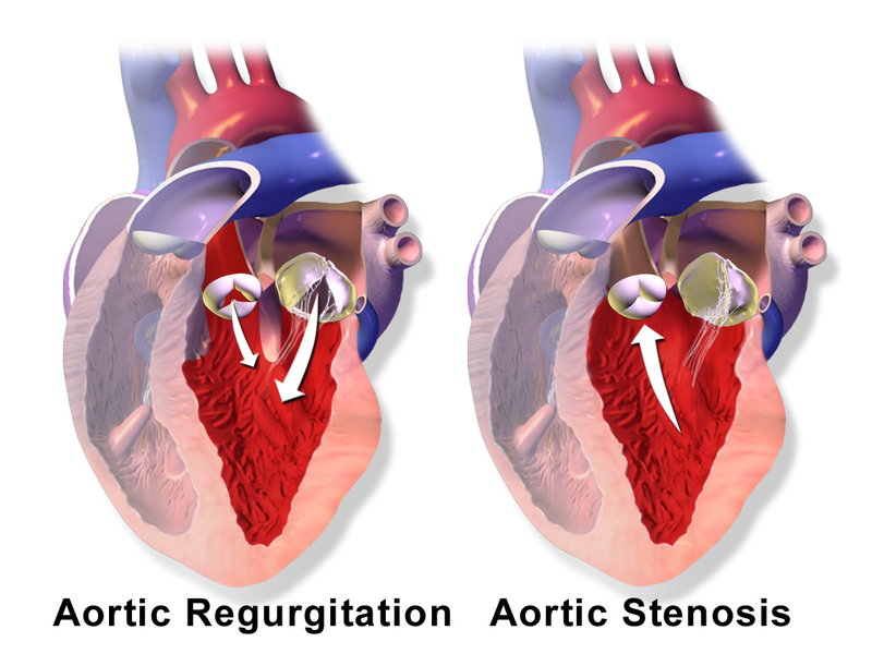 File:AorticValve RegurgitationvsStenosis.png