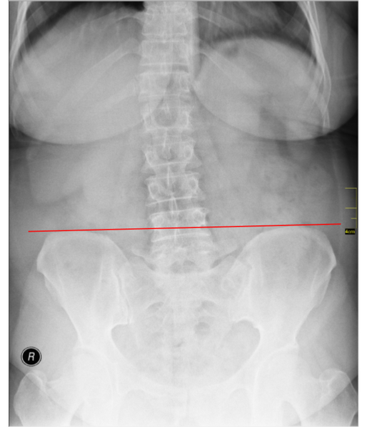 File:Small Lumbar Scoliosis Curve with Pelvic Torque.png
