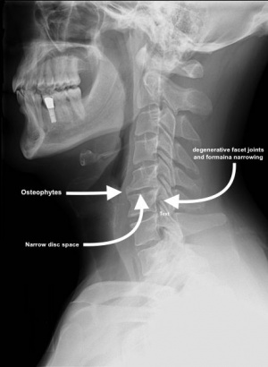 Cervical Spondylosis - Physiopedia spine diagram canal 