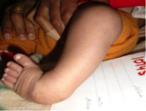 Case Study- Idiopathic Unilateral Clubfoot 1.png
