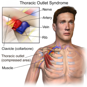 Thoracic Outlet Syndrome.png