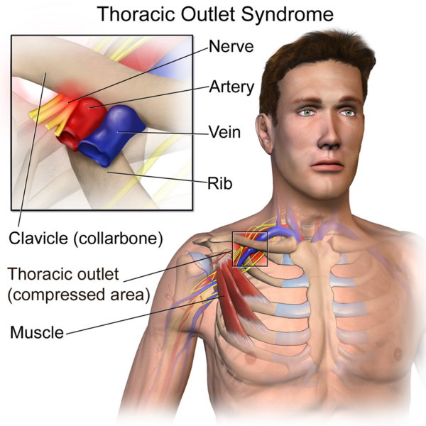 File:Thoracic Outlet Syndrome.png