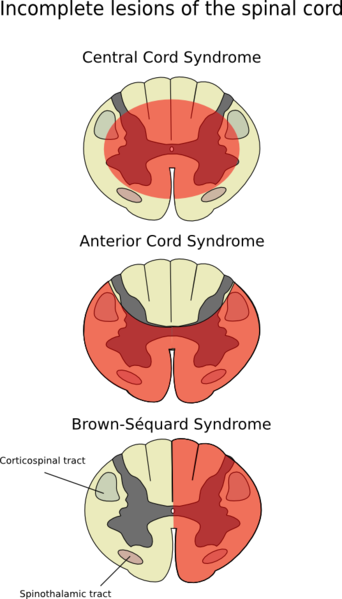File:Incomplete Spinal Cord Injury.png