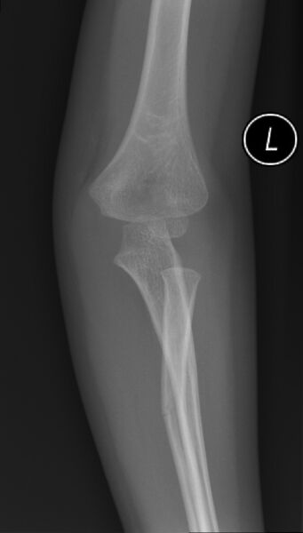 File:Type 3 Fracture.jpg