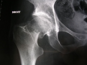 Neck of femur fracture (garden IV).jpeg