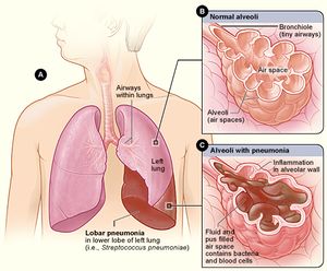 Pneumonia Inflammation.jpg