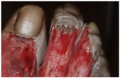 White areas in periwound between toes demonstrate maceration.