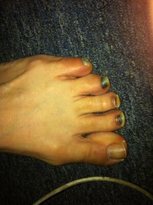 Runner's toes.jpg