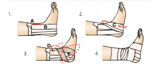 Ankle Sprain - Physiopedia