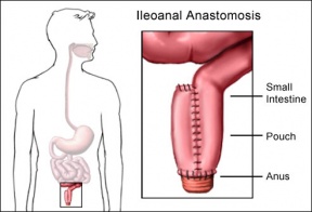 CRC ileoanal Anastomosis.jpg