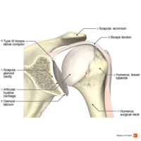 Illustration of type III biceps labral complex Primal.png