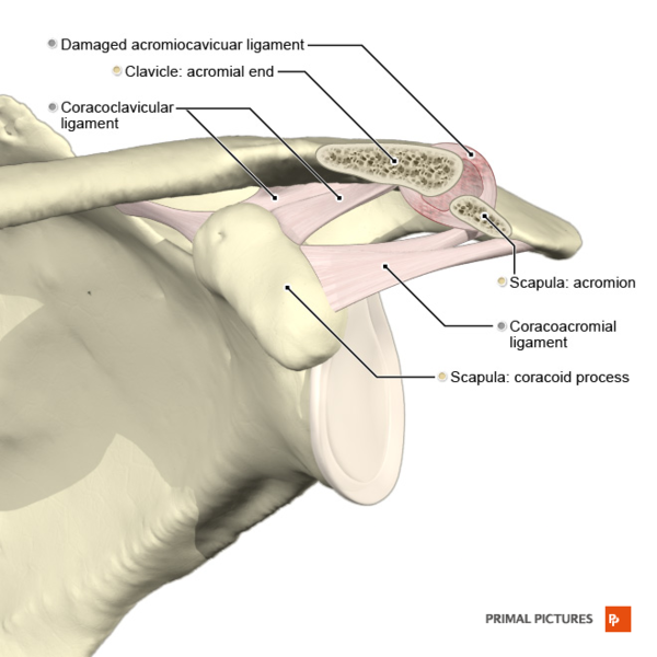 File:Acromioclavicular separation type 1 Primal.png