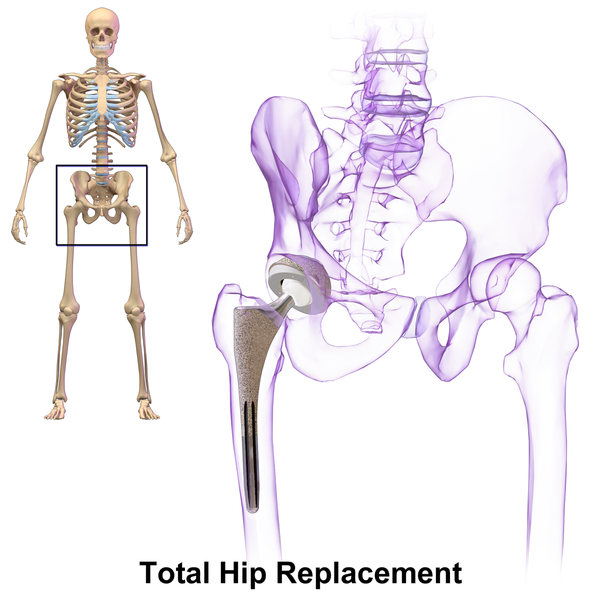 File:Hip Replacement.png