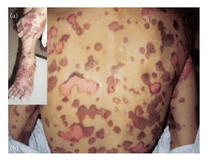 Linear IgA Bullous Dermatosis .jpg