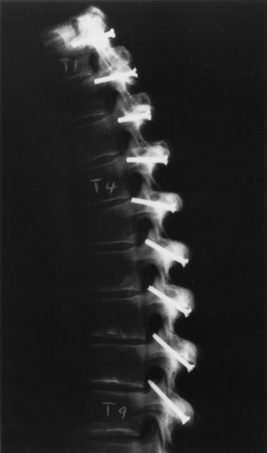 Rx colonna vertebrale.png