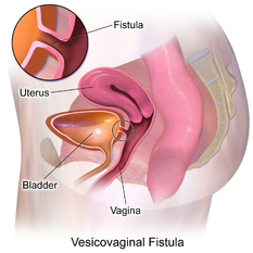 Vesicovaginal Fistula..png