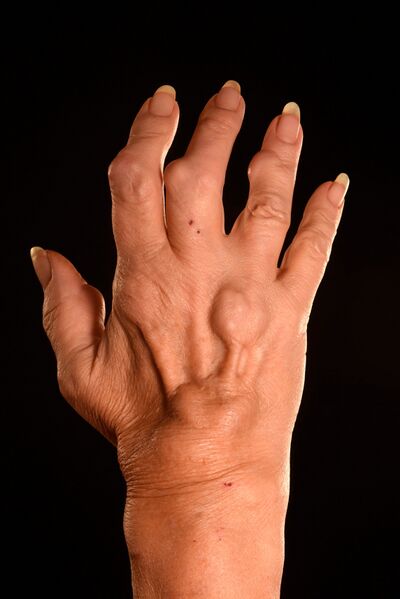 File:Rheumatoid Arthritis hand.jpeg