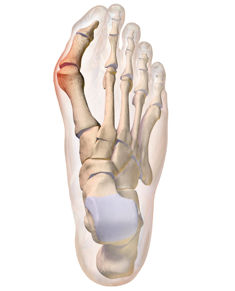 File:Bunion (cropped).png