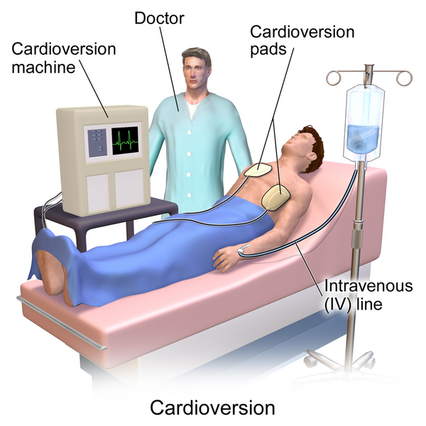 File:Cardioversion.png