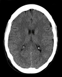 CT scan brain.jpg