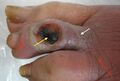 Yellow arrow denotes black eschar, white arrow shows macerated periwound, red areas indicate areas of erythema.