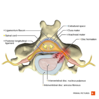 Posterolateral disc hernia axial view Primal.png