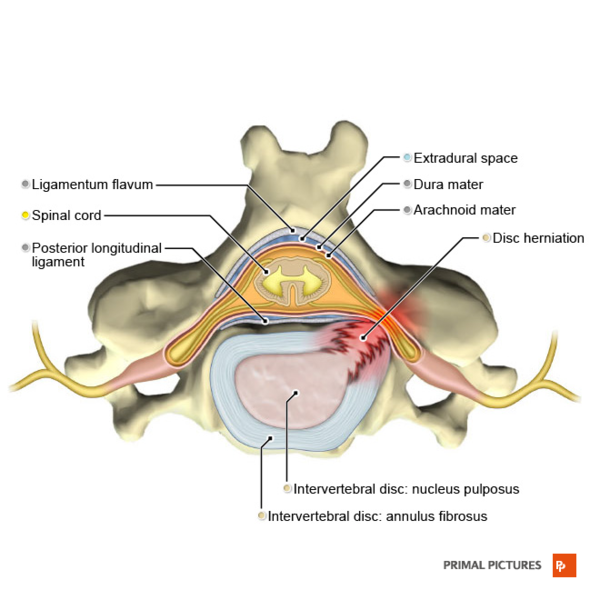 File:Posterolateral disc hernia axial view Primal.png