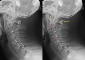 X-ray of the cervical spine with a Hangman's fracture. Left without, right with annotation. C2 (outlined in red) is moved forward with respect to C3 (outlined in blue).