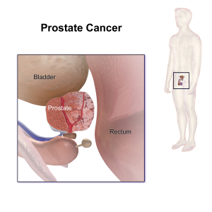 Abnormal Prostate Gland