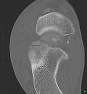 Calcaneal Fractures - Physiopedia