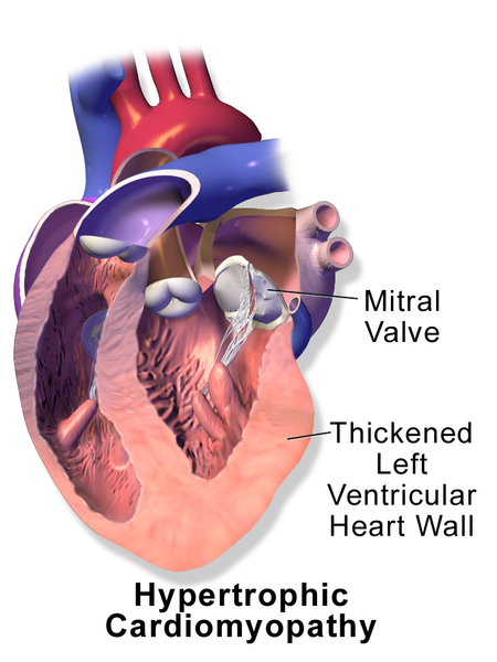 File:Cardiomyopathy Hypertrophic.png