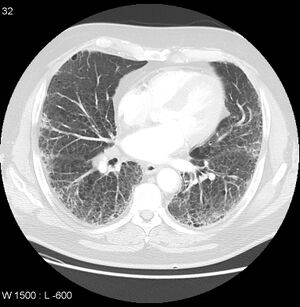 Rheumatoid lung.jpeg