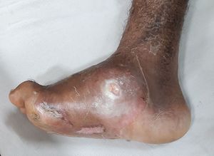 Diabetic Charcot Foot Deformity.jpg