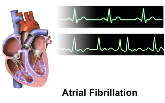 Atrial Fibrillation - Physiopedia