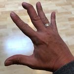 https://www.physio-pedia.com/images/thumb/b/b4/Mallet_Finger_Injury.jpg/150px-Mallet_Finger_Injury.jpg