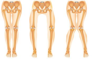 Figure 1. From left to right: knee with normal alignment, genu varus and genu valgus.
