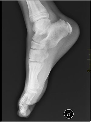 Medical X-Ray imaging Sever's Disease.jpg
