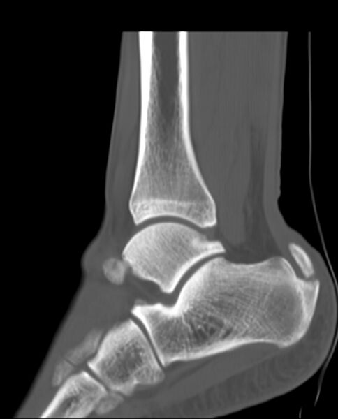 File:Insertional-achilles-tendinopathy-and-calcific-enthesopathy.jpeg