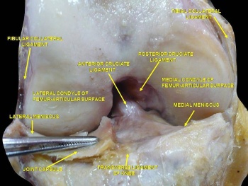 ACL dissection from anterior.JPG