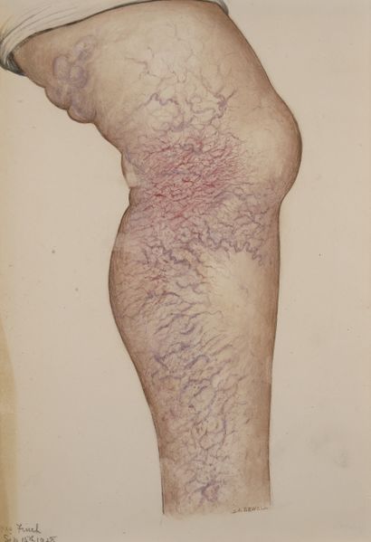 File:Extensive varicose veins.jpg