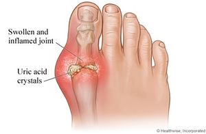 Gout foot.jpg