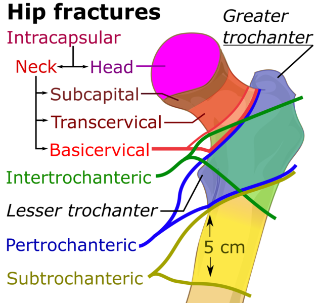 File:Hip fracture classification.png