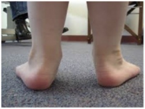 Pronated-Kids-Feet-400x301 (1).jpg