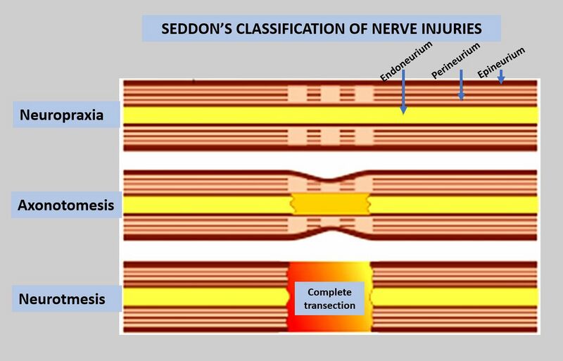 File:Seddon's - Classification of Nerve Injuries - Wikimedia Commons.jpg