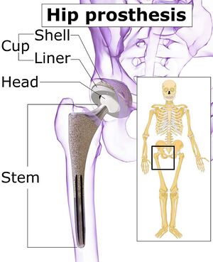 Hip prosthesis components
