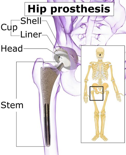 File:Hip prosthesis components.jpeg
